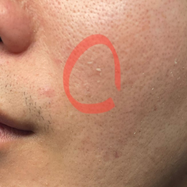 角質培養4日目角質培養日記