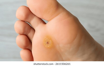 帯状疱疹・タコ、魚の目石野病院