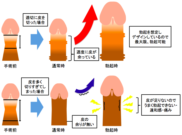 小陰唇縮小術・副皮除去・陰核包茎 | 金沢 美容外科 eクリニック【公式】埋没法