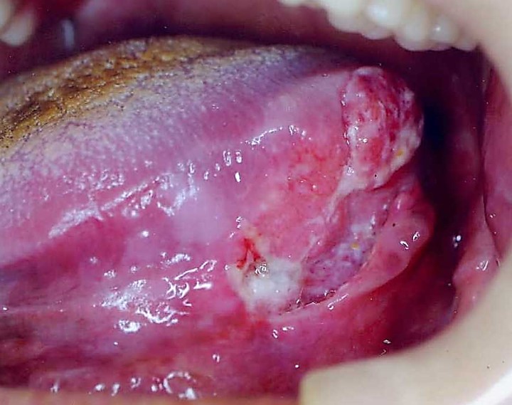 猫の鼻腔内リンパ腫について鼻の中に腫瘍ができることがある