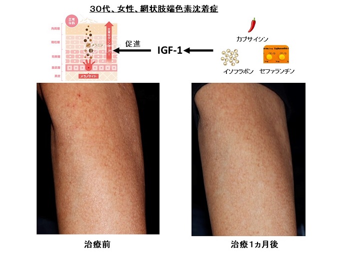 白斑 尋常性白斑まつもと皮膚科クリニック福知山・丹波・丹波篠山市の皮膚科・美容皮膚科
