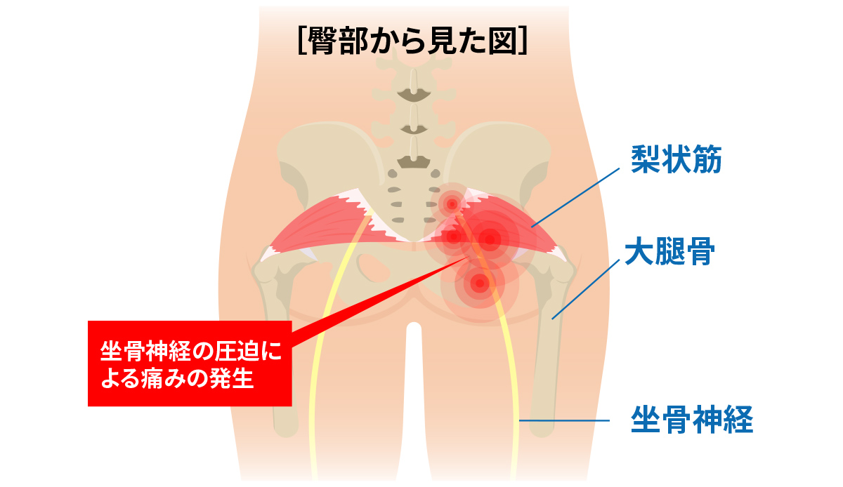 坐骨神経痛』とは？痛みの原因となる疾患とおすすめのストレッチ方法をご紹介カラダケア研究所MEDIAID Online – メディエイド公式オンラインショップ