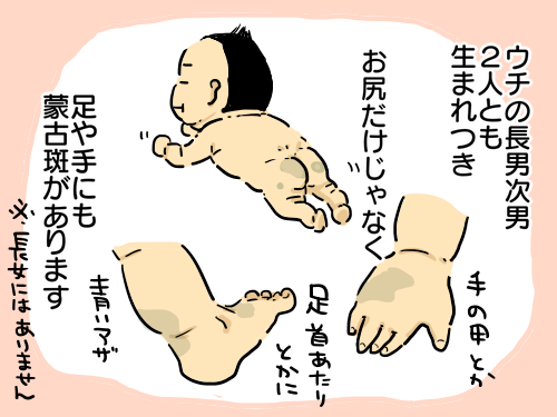 生まれたときから背中に色の濃いあざが２つ。「自然には消えない」と言われ、レーザー治療を決意 異所性蒙古斑・体験談 たまひよ