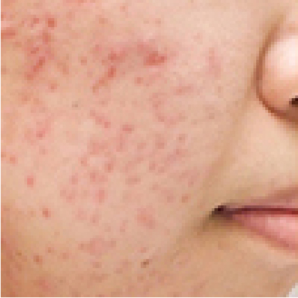 左頬・右頬の片方にできるニキビの原因と治し方を解説！治らないときの対処法は？ハダメディア by BIHADADO.TOKYO