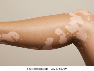 尋常性白斑は治った人がいる？自然治癒から最新治療まで徹底解説治験モニターのススメ