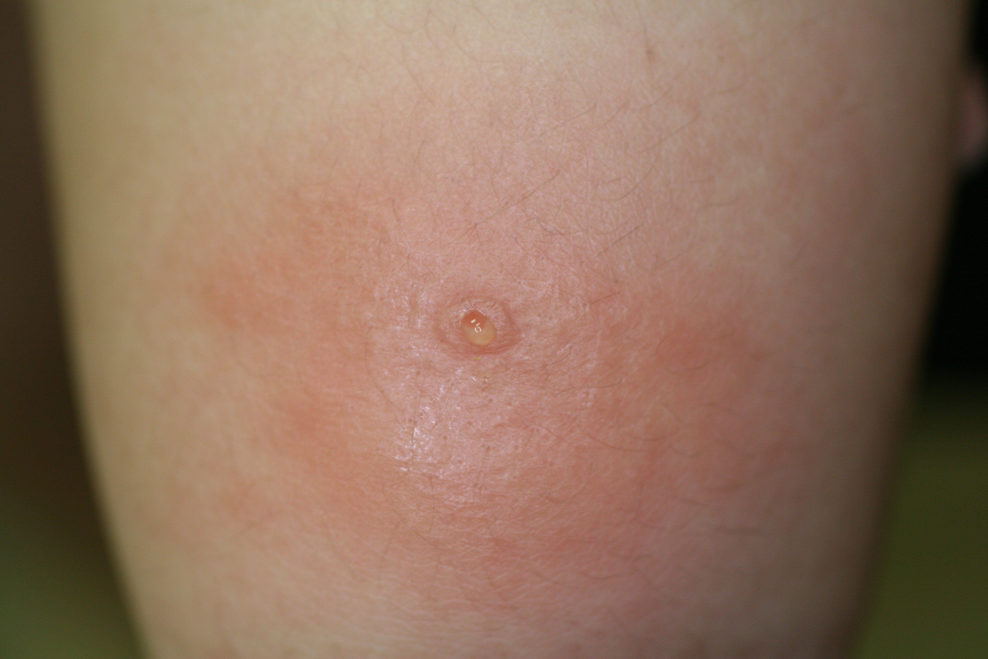 登山での虫刺され侮るなかれ！！。ブヨ ブキタカゼさんのモーメントYAMAPヤマップ