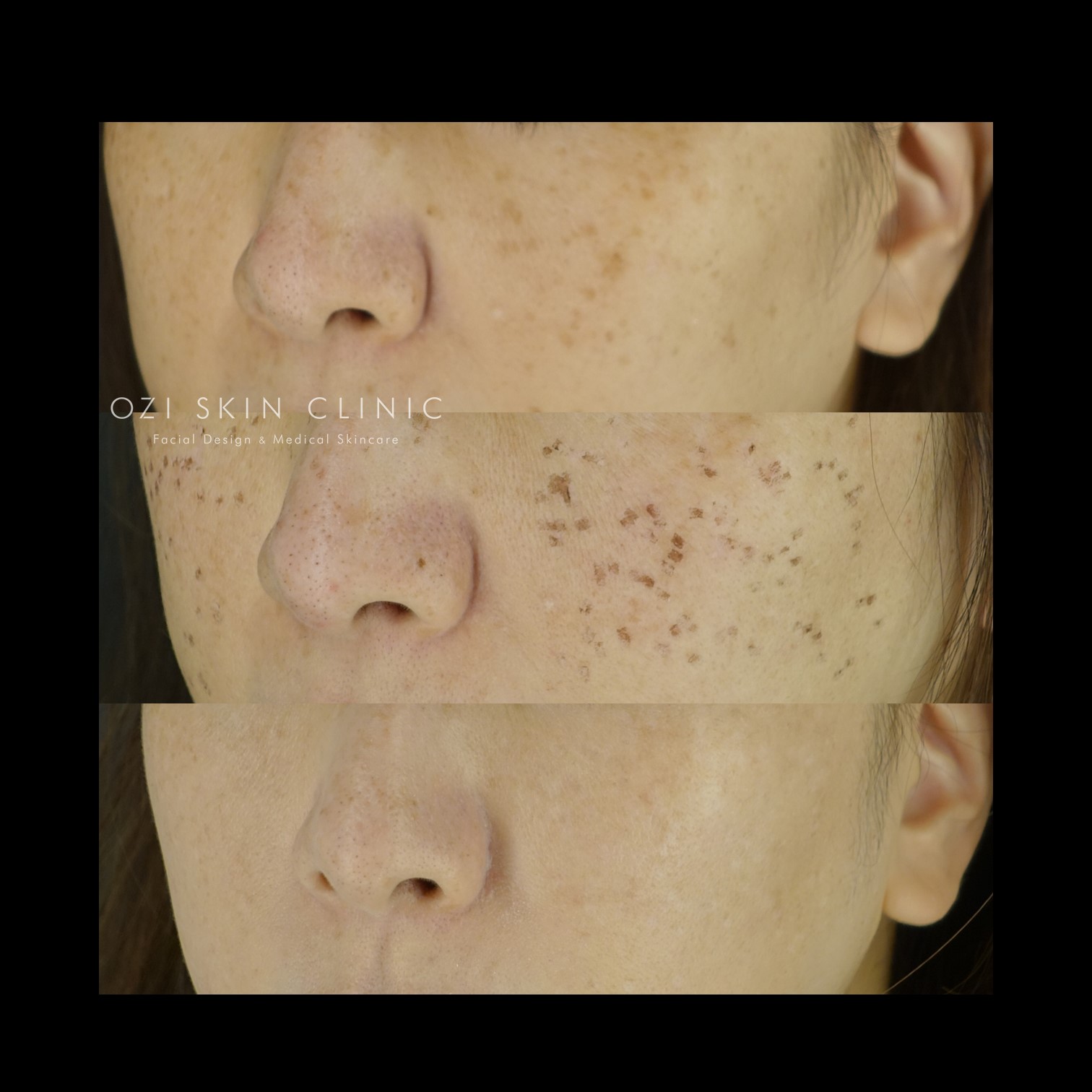 手 身体 のシミレーザーの経過の写真を載せてみます。やさしい美容皮膚科・皮フ科 秋葉原院 コラムレーザー治療、アトピー性皮膚炎