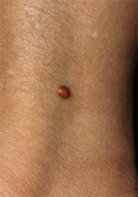 皮膚線維腫の摘出です北千住静脈瘤クリニック