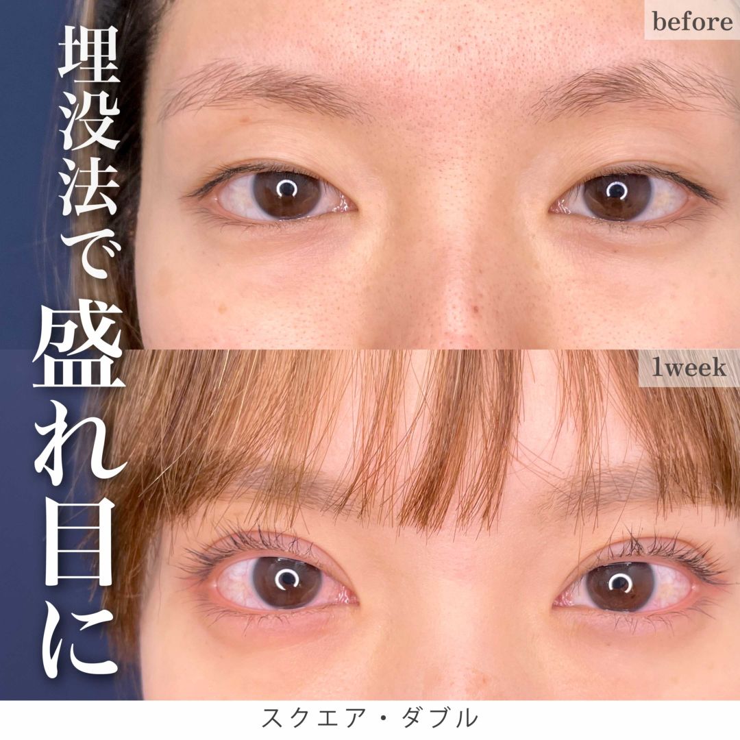 腫れ・内出血早く治したい！脂肪吸引注射ダウンタイムの過ごし方 - 渋谷院