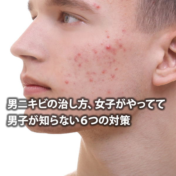 痛い頭皮ニキビの原因とハゲる理由！シャンプーと薬でケアする方法ヘアメディカル