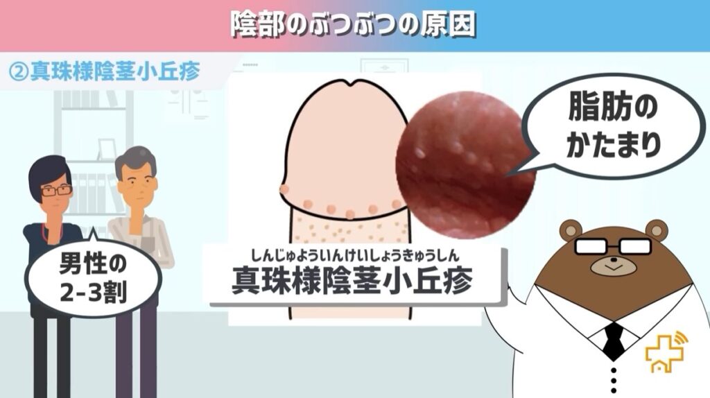 ウイルス性イボ尋常性疣贅- 上野御徒町ファラド皮膚科