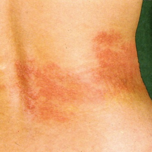 帯状疱疹よく見られる大人の病気 - みやけ内科・循環器科 家庭の医学