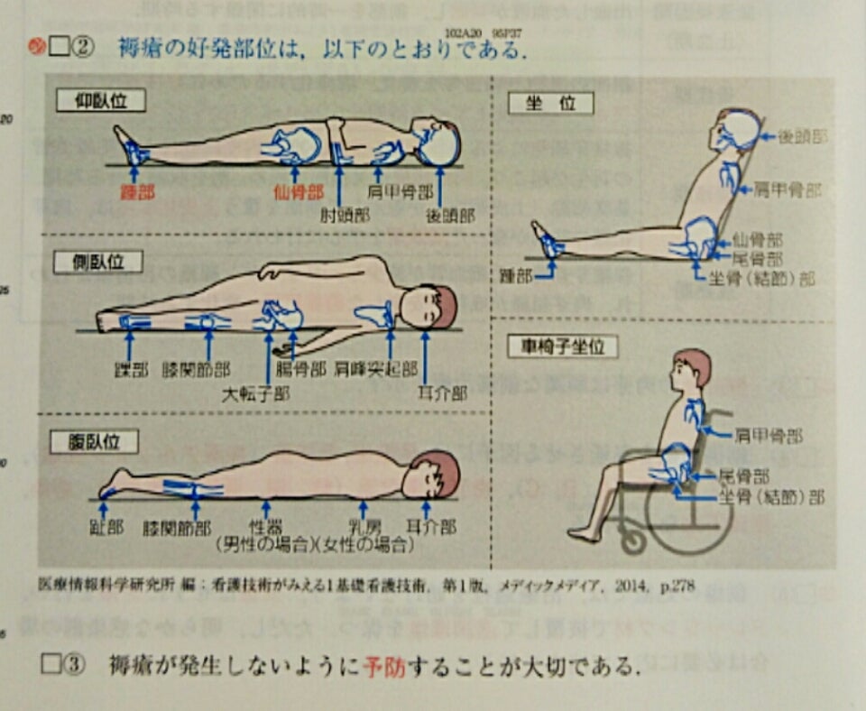 褥瘡 床ずれ の予防について