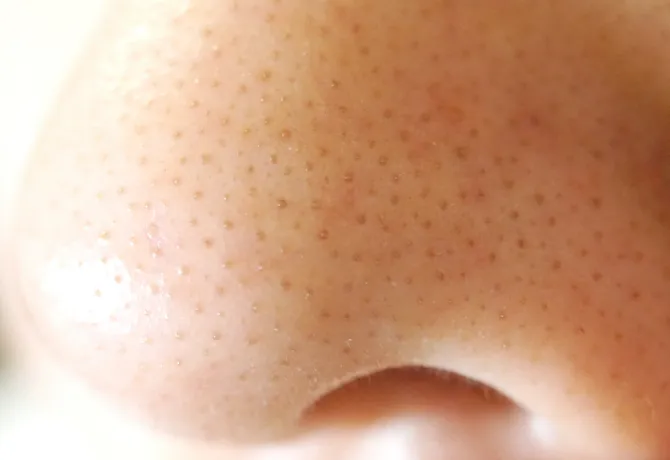 ASCII.jp：毛穴を10倍拡大できるスマホ連動の“角栓吸引型”ビューティデバイス