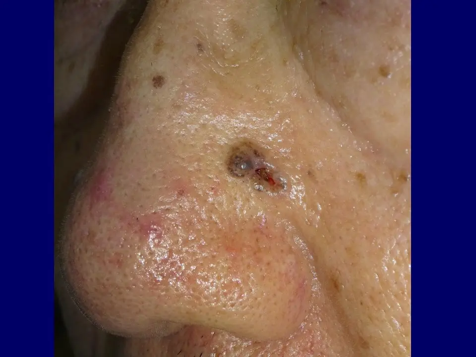 お鼻の中にあるできもの、除去できます♪目黒駅前アキクリニック