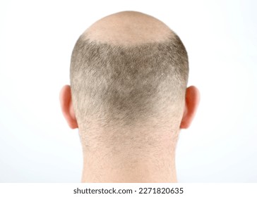 M字ハゲの基準や対策とは？生え際が後退する原因と治療方法について湘南AGAクリニック-AGA治療・薄毛治療・自毛植毛