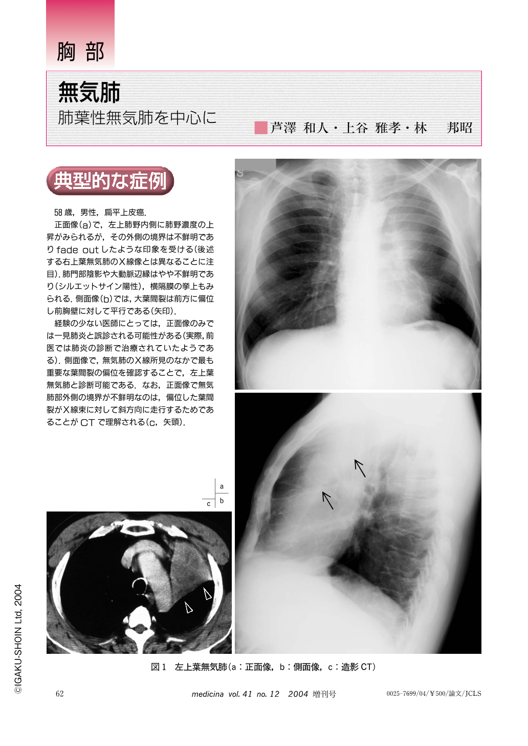 今日の症例・無気肺で肺が縮むということ２: やさしイイ呼吸器教室