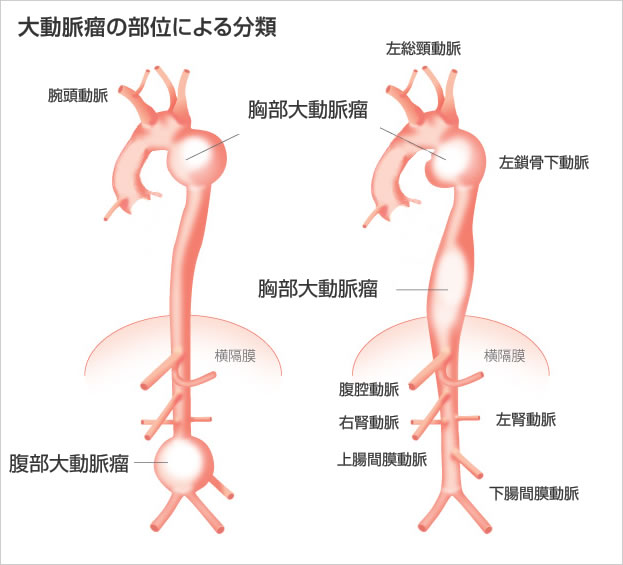 大動脈疾患千葉大学大学院医学研究院 心臓血管外科学