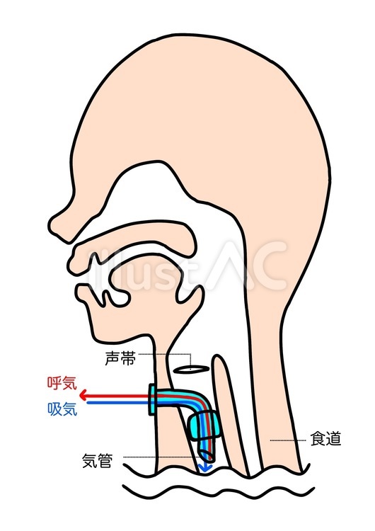 気管切開のイラストかわいいフリー素材集 いらすとや