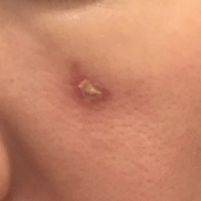 毛孔性苔癬の治療方法と美容医療についての注意事項