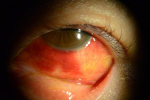 目の充血について 赤ちゃんの病気・ケガ ベビーカレンダー専門家相談