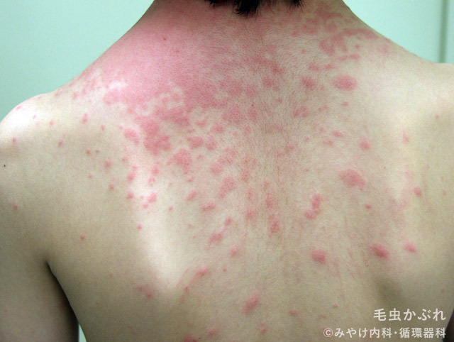 毛虫皮膚炎白崎医院blog 高岡市の皮ふ科 子どもの皮ふ 美容皮膚科