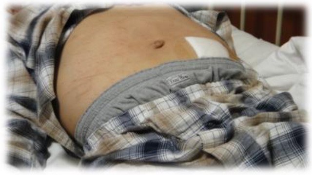 腹水 1,2枚目 11 11 3枚目 9 20「腹水」って調べると「末期」「余命1,2ヶ月」とか書いてある。 俺も専門領域の知識として、 「腹水になると 」ってのは知っている。けれども抗がん剤等により身体のバランスが崩れて腹水が起こる 場合もある。 もちろん、が