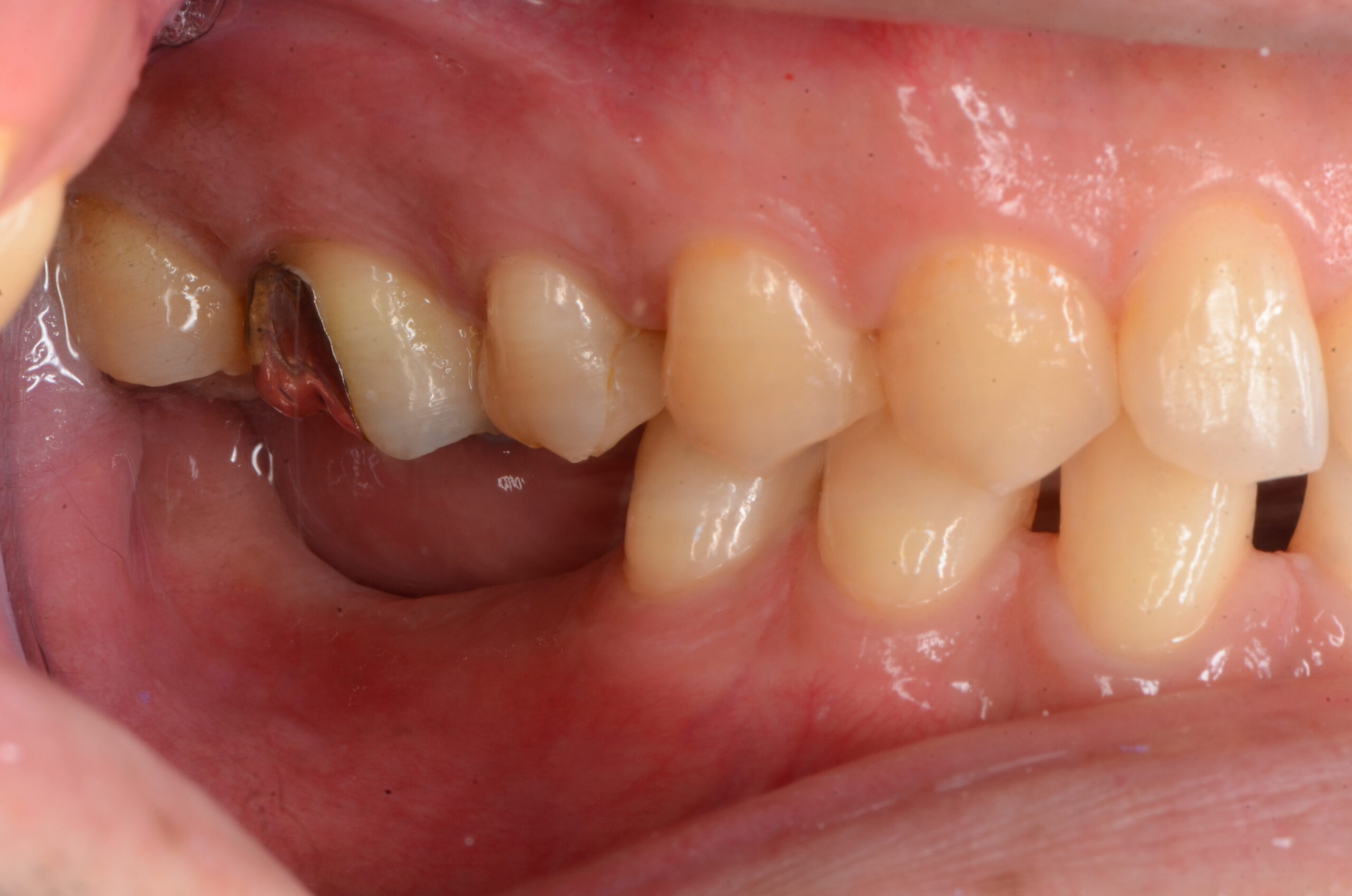 入れ歯の仕組み大倉山駅前港北歯科クリニック