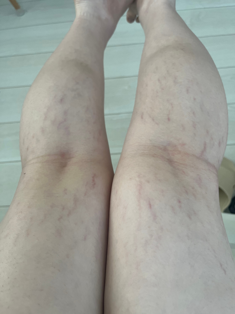 死にたいこんにちは中学3年の女子です気付いたら肉割れが出てててこんなに肉割れが- Yahoo!知恵袋