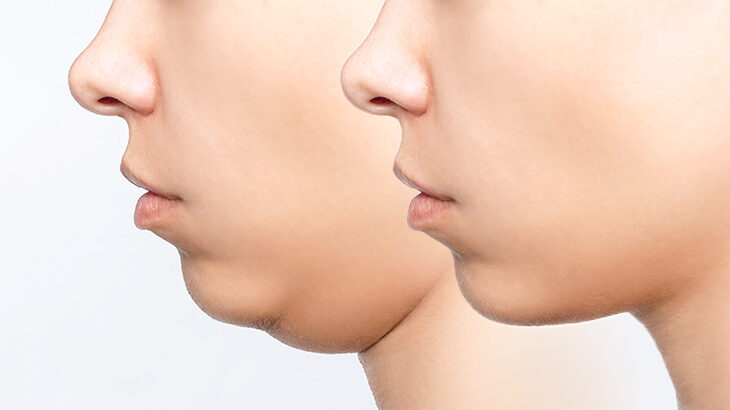 頬が出てる気がするのですがこれは頬骨が張っているのでしょうか、それとも頬肉が厚- Yahoo!知恵袋