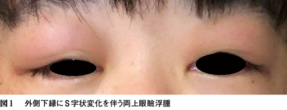 まぶたや目元の腫れの原因土呂駅・加茂宮駅の眼科ならステラタウン3階のあさい眼科