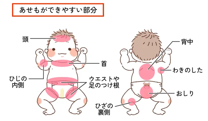 医師監修 赤ちゃんのあせもの治し方・予防方法ベビーカレンダ