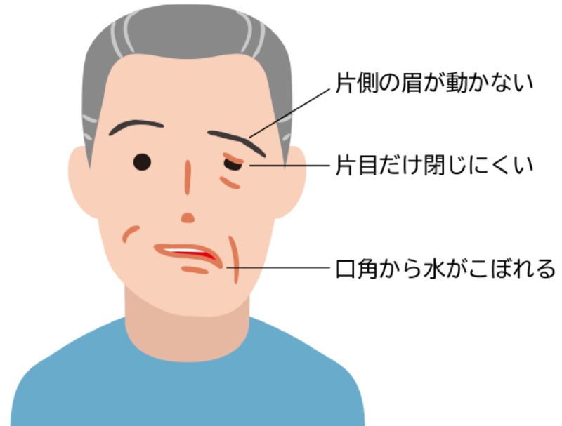 脱力感や動きの悪さにへいファミリークリニック千葉 旧：にへい脳外科