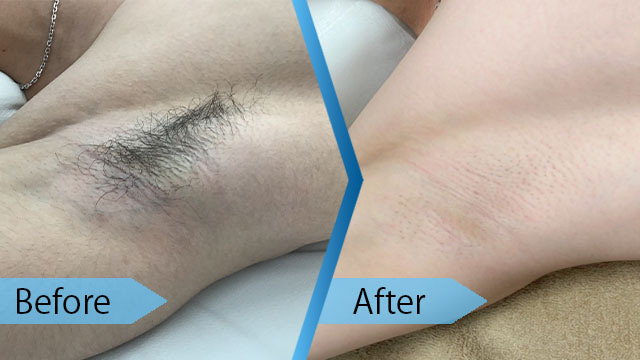 メンズの足脱毛 すね毛・太もも は何がおすすめ？セルフや医療脱毛の違いを解説 – MEN'S UP メンズアップ▻ 渋谷駅徒歩5分 メンズ専門アートメイク&脱毛 美容クリニック