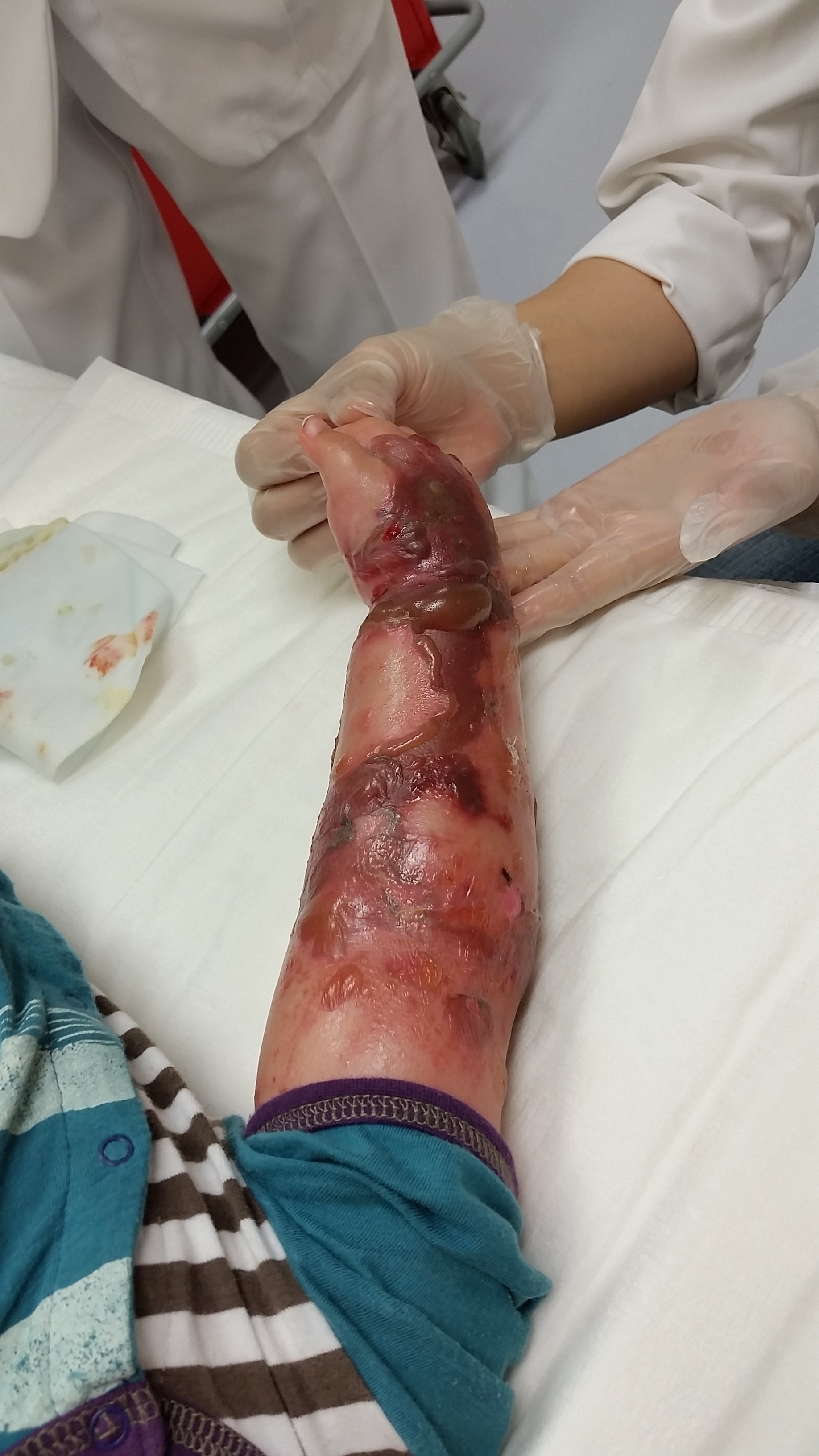 涙袋にヒアルロン酸注射は危ない？デメリットや失敗例と回避方法笹塚駅前こたろ形成皮ふ科クリニック京王線「笹塚」駅すぐ形成外科、皮膚科、美容外科、美容皮膚科