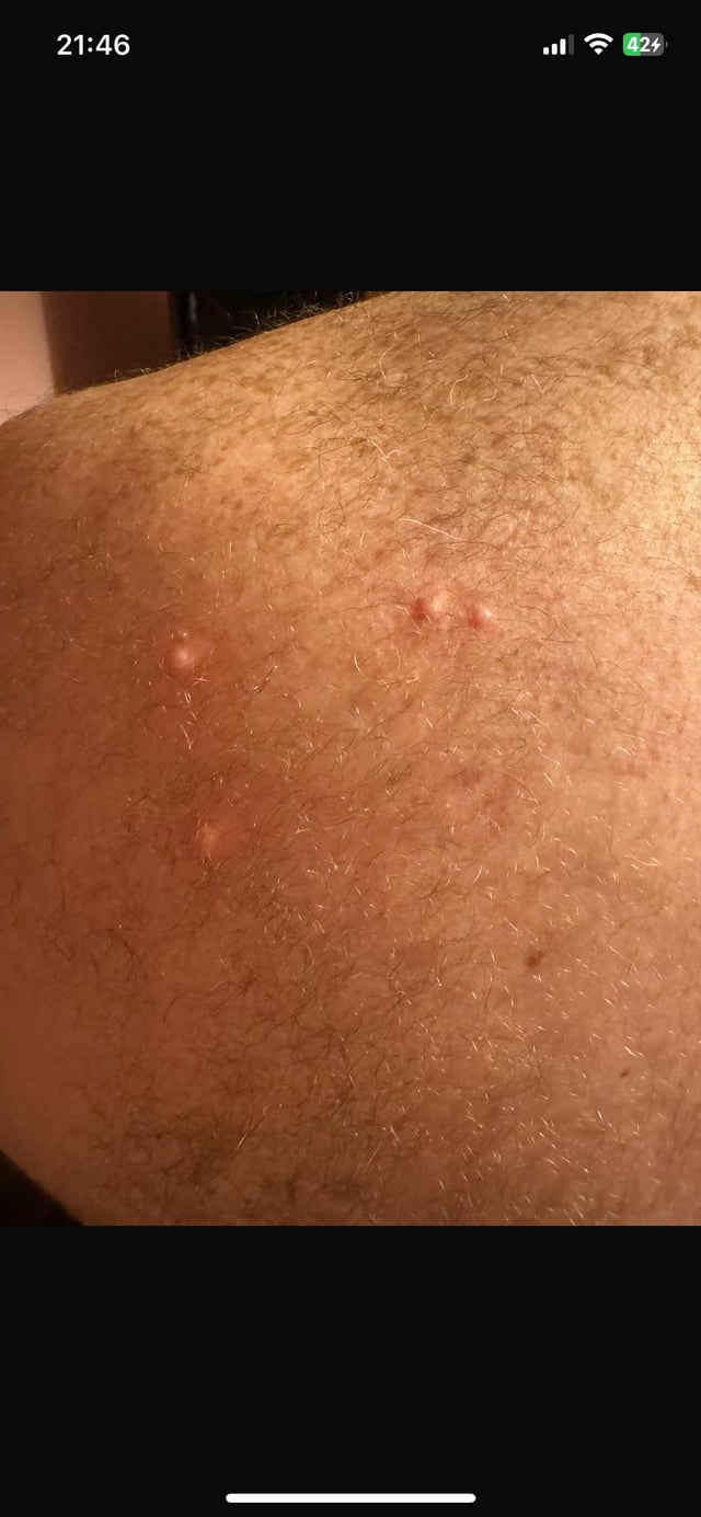 トコジラミに刺されたらどんな跡が残る？予防方法を解説