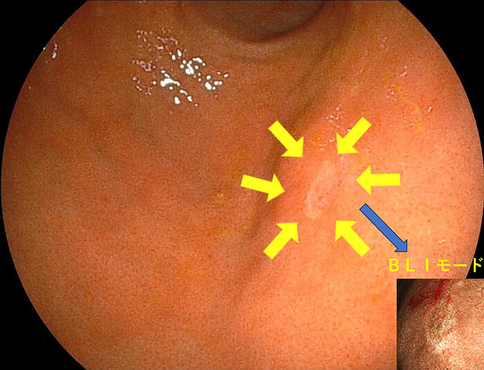 胃X線検査の撮影方法・画像の見方 - 第1種放射線取扱主任者試験対策