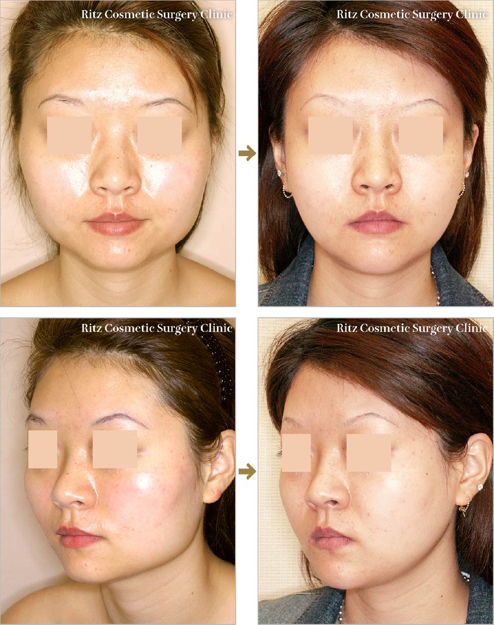 頬骨の高さが違うなおす方法中目黒整体レメディオ