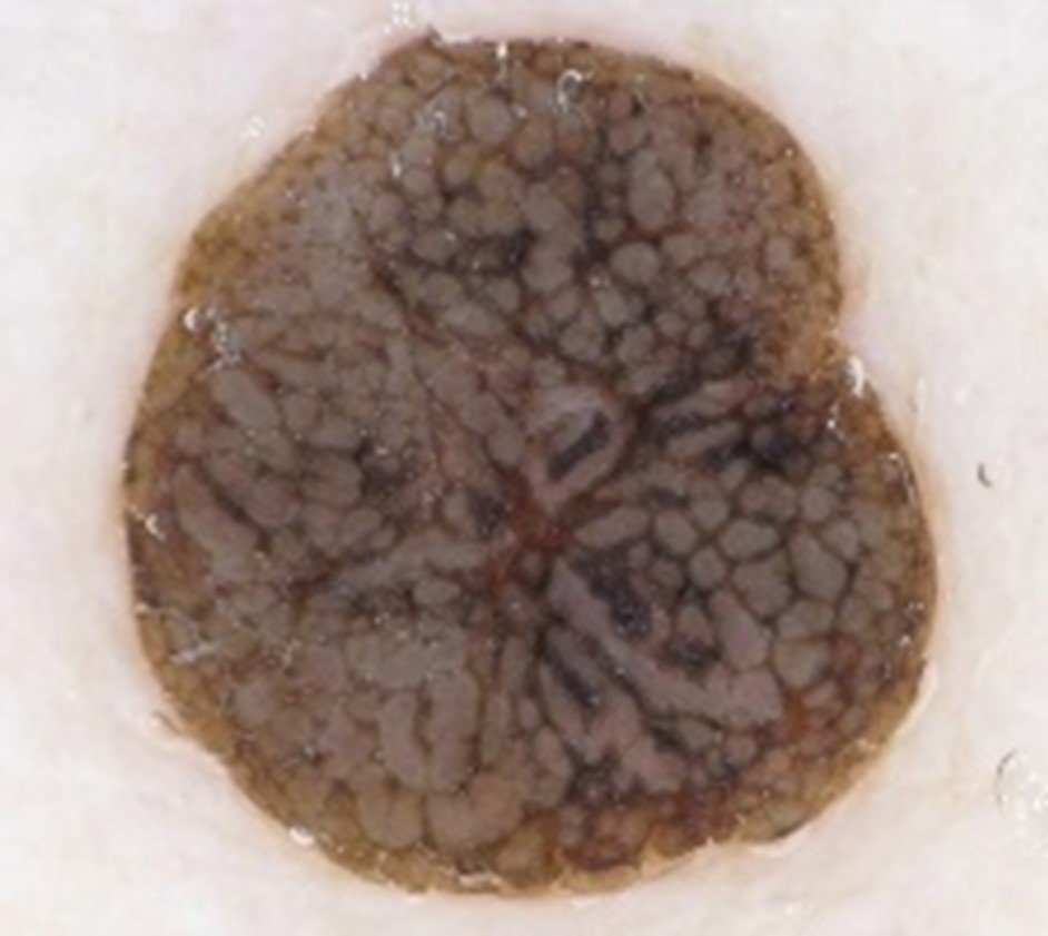 宮崎台・梶が谷・鷺沼でいぼ・水いぼの治療なら宮前区の宮崎台スキンクリニック