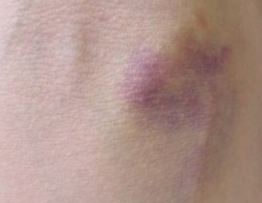 血液専門医が解説 紫斑病の症状・診断・治療上野駅2分 内科・血液内科・糖尿病内科上野御徒町こころみクリニック