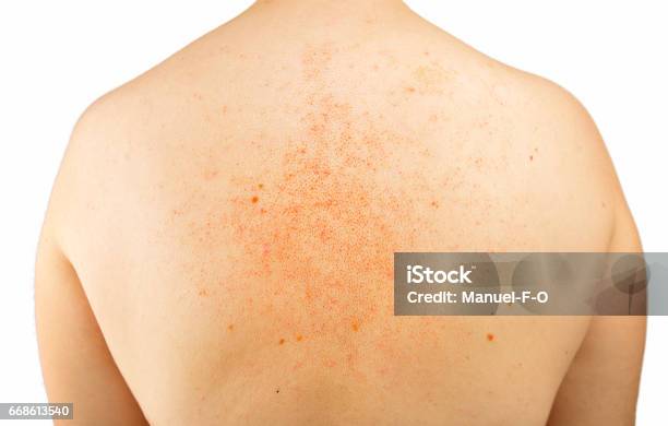 女性のアトピー性皮膚炎に特有な背中の肌荒れの改善例！美保薬局福島県いわき市の皮膚病お悩み相談専門の経験豊富な薬局です