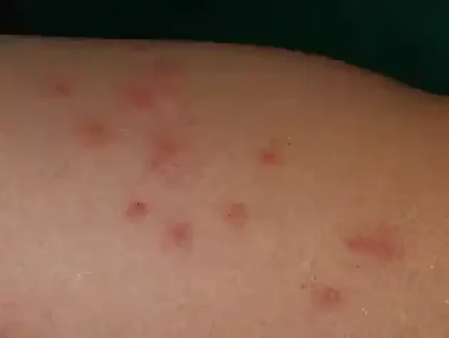 ノミに刺されたときの対処法は？他の虫刺されとの見分け方や予防法も解説