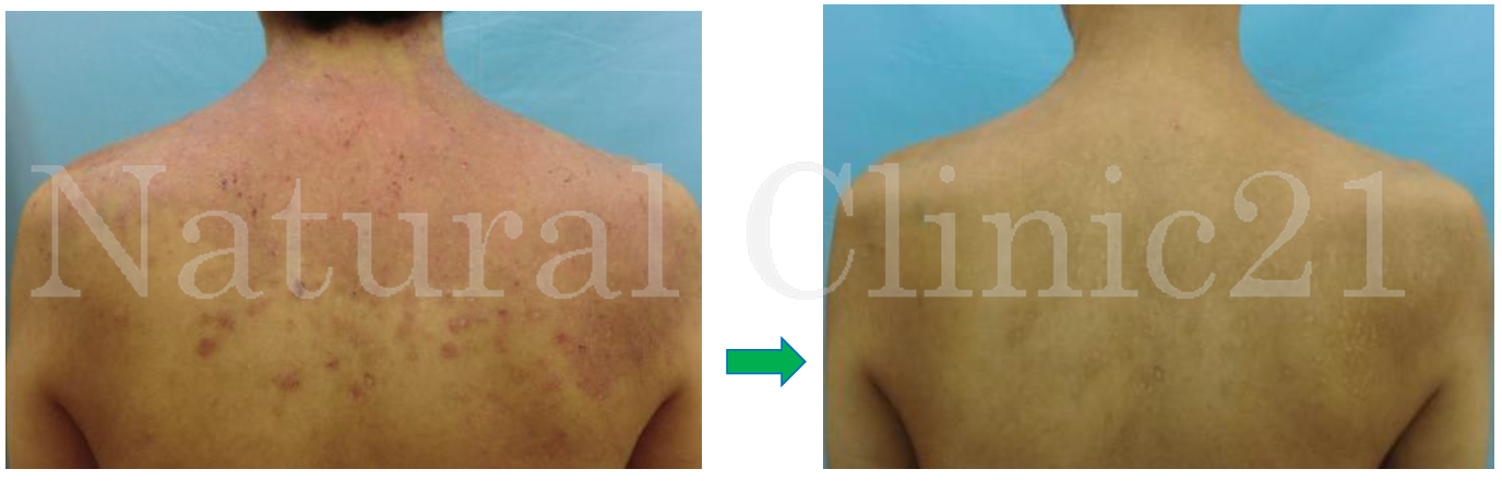 アトピー性皮膚炎茨木市総持寺の小児科みやざきちびっこ診療所乳幼児健診・予防接種