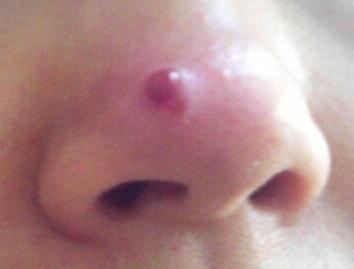 鼻の上に大きなニキビ めんちょ？ ができてしまいました。潰そう- Yahoo!知恵袋