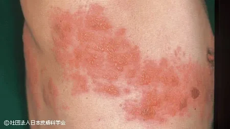 帯状疱疹 Herpes Zoster