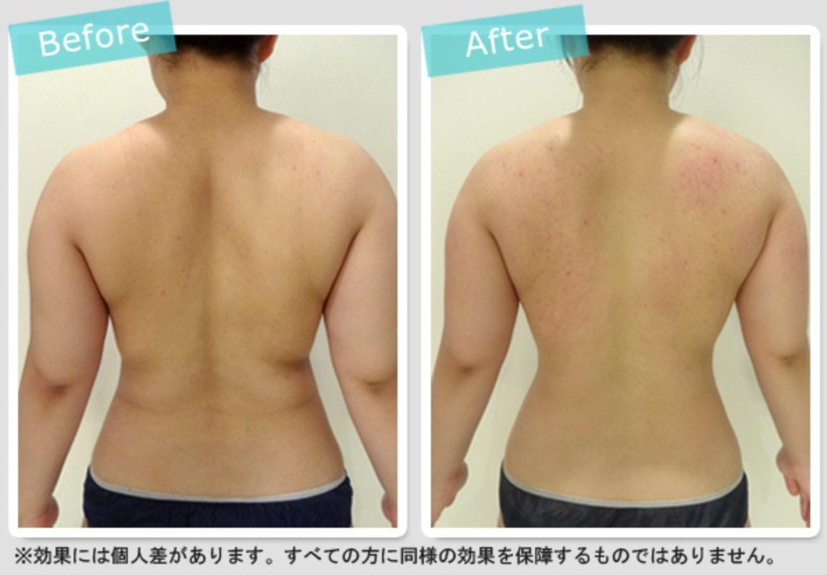 全身まるごと痩せ放題90分×2回 爆燃焼マシン＋針無脂肪レスマシン￥11,000 東京銀座、新宿のエステサロン 痩身＆肌改善 オリエンタルエステエスプリ