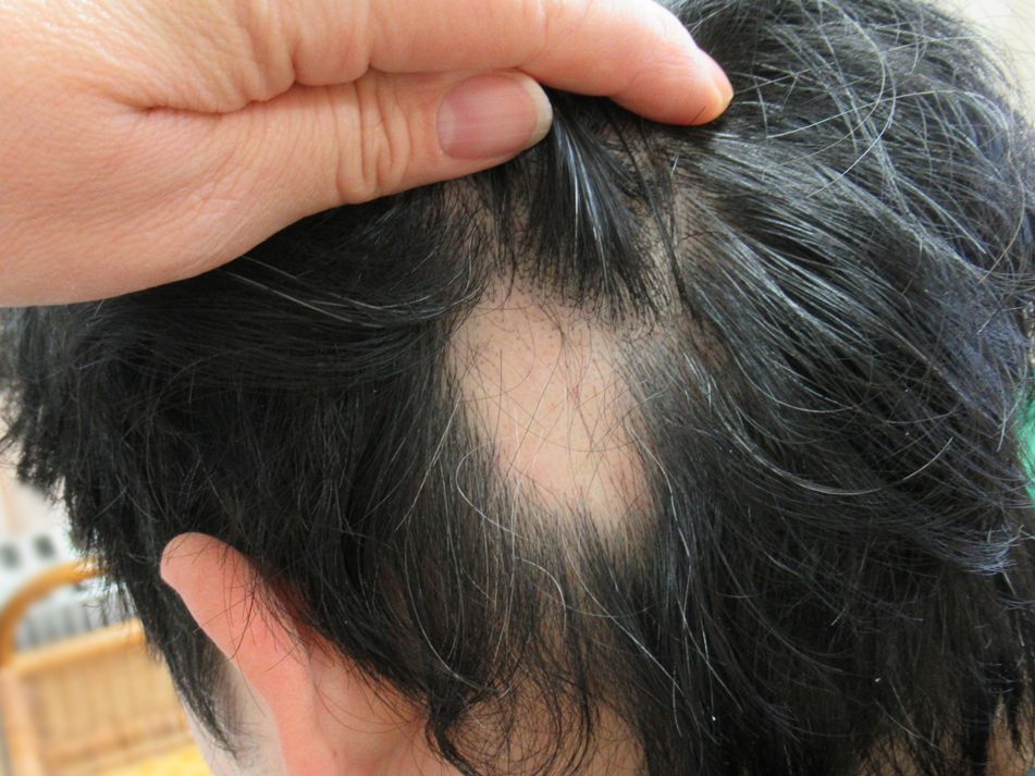 四日市在住 中学生女子 薄毛のお悩みLEAF
