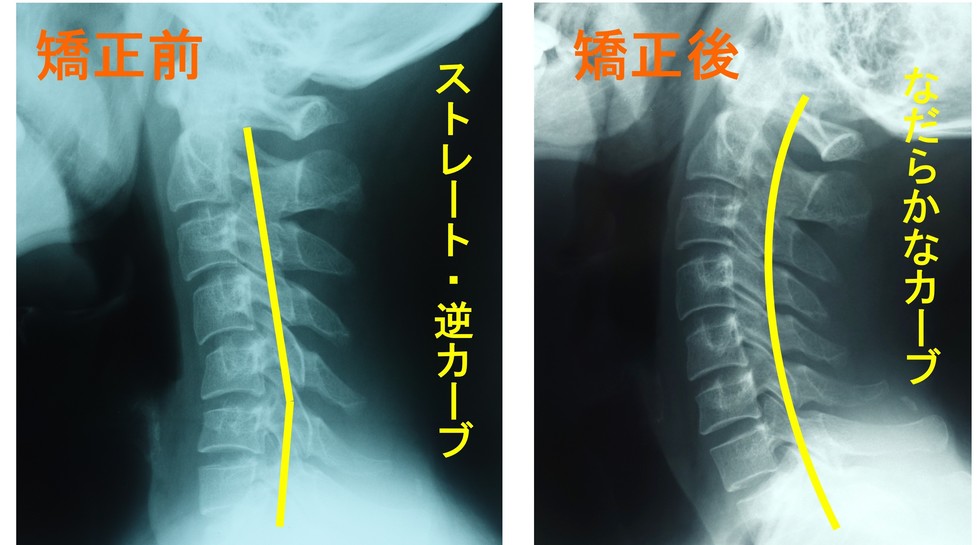 顔が前に出ている姿勢を自分でなおすラファカイロプラクティック