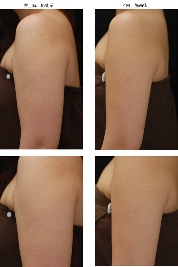 ステロイド軟膏の長期使用のよる皮膚苔癬化 たいせんか の改善美保薬局福島県いわき市の皮膚病お悩み相談専門の経験豊富な薬局です