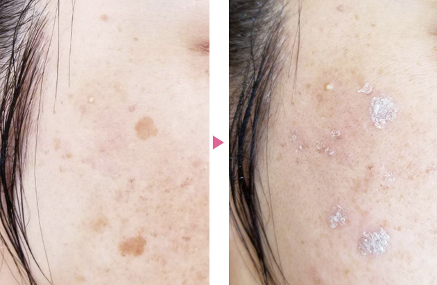 シミレーザー治療経過と処置 - 東京・大阪の美容皮膚科ならFLALU フラルクリニック